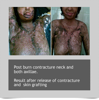 Reconstructive Surgeries for Post Burn deformities